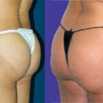 Lipo κοιλιά