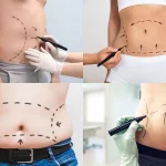 LIPOSUCTION PSMEDICAL