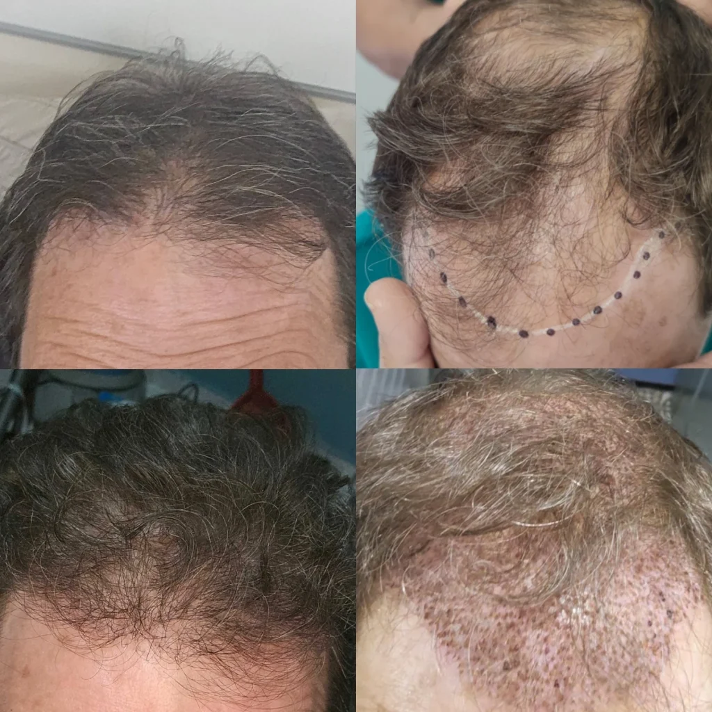 100% ακούρευτη μεταμόσχευση μαλλιών πριν και μετά – PS Medical