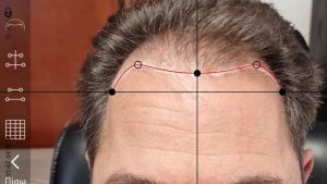 Σχεδιασμός Hairline σε Πιστοποιημένη Κλινική πως γινεται ο σχεδιασμος hairline σε πιστοποιημενη κλινικη