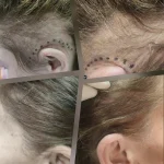 Πύκνωση Φαβορίτες με Ακούρευτη FUE