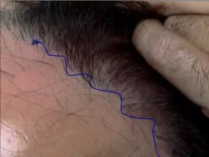 Σωστή Hairline - Frontline