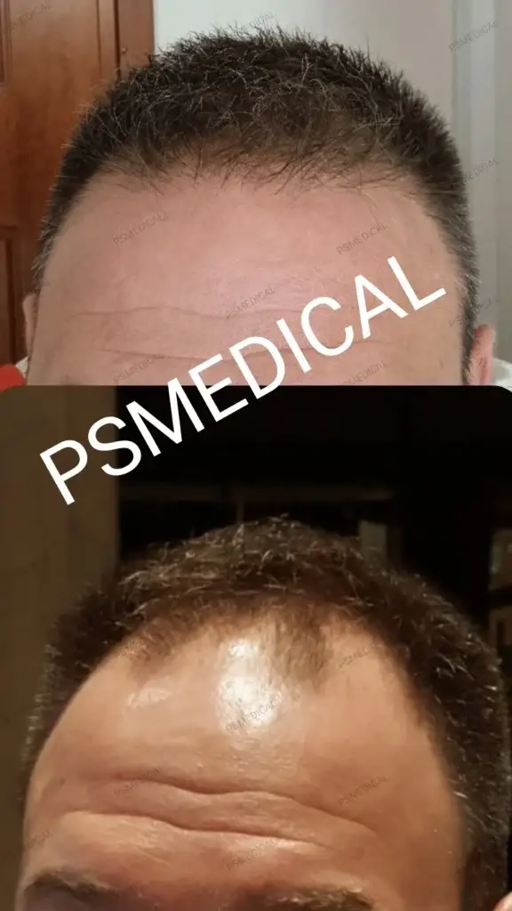 100% ακούρευτη μεταμόσχευση μαλλιών πριν και μετά – PS Medical
