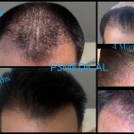 Πριν-4 Months-10 Months