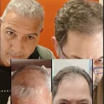 5μηνο unshaved FUE