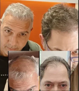 5μηνο unshaved FUE